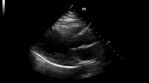 Not everything that wheezes is asthma. Stress cardiomyopathy can mimic respiratory distress, leading to misdiagnosis. Bedside echocardiography should be your first step when the clinical picture doesn’t fit. https://ow.ly/GAgY50XJWv5 | Emergency Medicine News