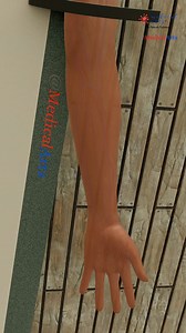 IV insertion GONE WRONG EP.3 Infiltration IV Infiltration: When Things Go Wrong 💉 Swelling, Cool Skin, Pain = Red Flag 🚨 Always double-check placement! Ever wondered what happens when IV fluid leaks outside the vein? This short clip shows an infiltrated IV site—a common but painful complication. Watch for signs like sudden swelling, cool skin, and discomfort. #EmergencyMedicine #medicalstudent #nursingstudent #ivinsertion #ivcatheter #hospitallife #medicalprofessionals #humanbody #healthshorts