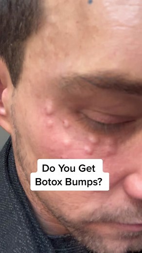 Botox Bumps: Understanding the Surface Injection Technique