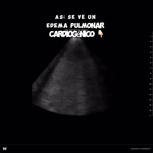 Cardiología veterinaria | Dr. Cisneros on Instagram: "🚨 El edema pulmonar en perros es más peligroso de lo que parece Muchas veces el edema pulmonar se confunde con una simple tos o “cansancio por la edad”. Sin embargo, en perros —especialmente en pacientes cardiacos— el edema pulmonar es una emergencia médica que puede poner en riesgo la vida. Cuando el corazón no logra bombear de forma eficiente, el líquido se acumula en los pulmones, dificultando el intercambio de oxígeno. El resultado es ah