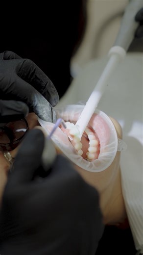 Composite bonding after invisalign