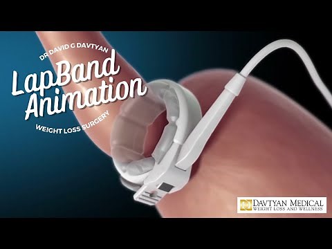 How Lap-Band Weight Loss Surgery Works: Procedure Animation