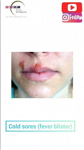 Ever seen these Blisters on someone's face? Find out what they are! #herpes #dental #face