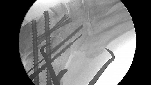 Acutrak 2® Triple Arthrodesis Cadaveric Surgery with Dr Abidi