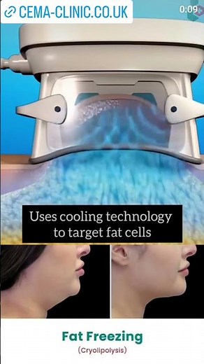 How Fat Freezing works?