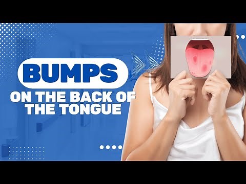 Bumps On The Back Of The Tongue: 5 Symptoms And Rare Causes