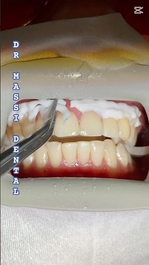 Teeth Zoom Whitening , Brilliant SMILE