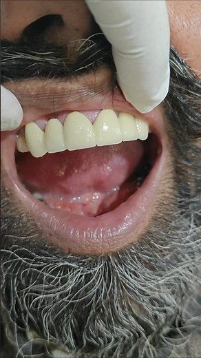 Porcelain-fused-to-metal (PFM) dental crowns combine a durable metal #dentalresin #dental