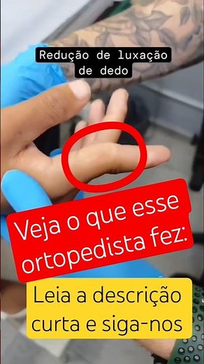 Finger Dislocation (Dislocated Finger) #orthopedics #youtubechannel #shortsfeed #shorts