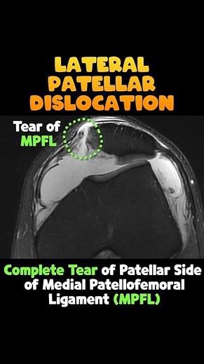 (Fig 4-A.26) Displaced Osteochondral Fragments in Patellar Dislocation