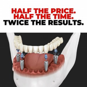 Need Dental Implants? Everything You Need to Know in 60 Seconds! | David M. White DDS