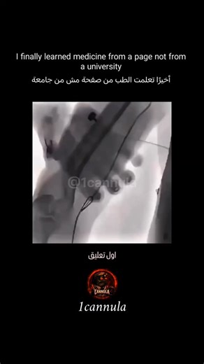 1cannula on Instagram: "🚨 Follow my account… or keep fearing what you don’t understand. On this X-ray, you see a metal wire inside a human foot. Your brain says: “Foreign object.” “Danger.” “Something went wrong.” But medicine tells a different story. 😨 What you’re seeing is a Kirschner Wire (K-Wire) — one of the most controlled and calculated tools in orthopedic surgery. When a fracture disrupts bone alignment, healing cannot happen correctly unless stability is restored. And stability requir