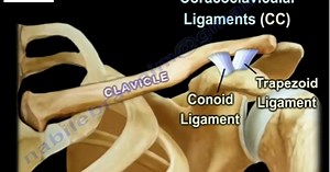 Clavicle Fractures
