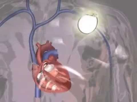 BSC T-ICD System Implant Animation