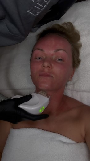 FIRST Skin and Body Adelaide on Instagram: "A needle-free alternative to traditional RF microneedling, RF FSR (Fractional Skin Resurfacing with Radio Frequency) from @endymedofficial delivers powerful results without the downtime. This advanced treatment resurfaces the skin’s top layer while deeply rejuvenating, tightening, and toning from within. It effectively reduces the appearance of: • Scarring • Stretch marks • Enlarged pores • Fine lines & wrinkles • Pigmentation The result? Smoother, bri