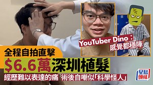 深圳植髮｜香港YouTuber豪花$6.6萬北上植髮 直擊8小時手術全過程 臉部腫脹自嘲似「科學怪人」