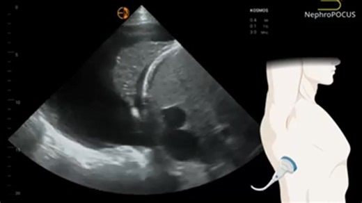 Un épanchement pleural droit à l'échographie 🔊 #medicine #medicalstudent #diagnosis #medlife #health #anatomy #radiology #pathology #humanbody #hospital #doctor #medschool #medecine #sante #anatomie #corpshumain #hopital #docteur #edn 👉 Pour soutenir la page, c’est ici : https://www.facebook.com/toutsavoirsurlamedecine/subscribe/ | Tout savoir sur la Médecine