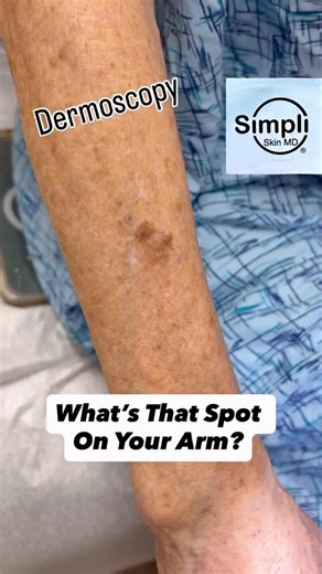 What’s That Spot On Your Arm? Come See What Your Dermatologist Sees!