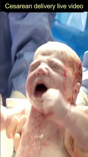cesarean delivery live video | #Shorts | normal delivery | newborn | newborn baby | c section