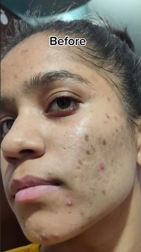 Tretinoin cream 0.025% before and after 1 YEAR OF TRETINOIN #tretinoin #shortsfeed #tretinoincream