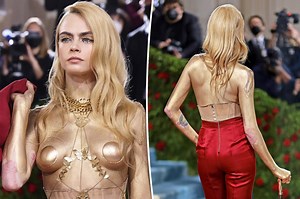 Cara Delevingne didn’t hide her psoriasis at Met Gala 2022