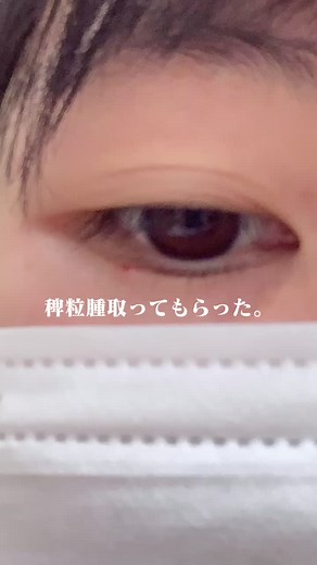 稗粒腫とは？広瀬すずの汗管腫に関する体験談