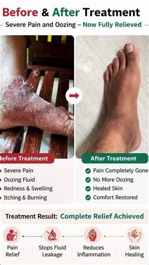 Severe Foot Eczema with Pain & Oozing Fluid – Complete Relief After Treatment | Real Patient Result