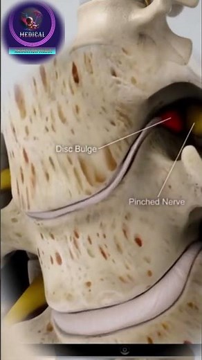 Spinal Disc Degeneration Causes, Changes & Symptoms