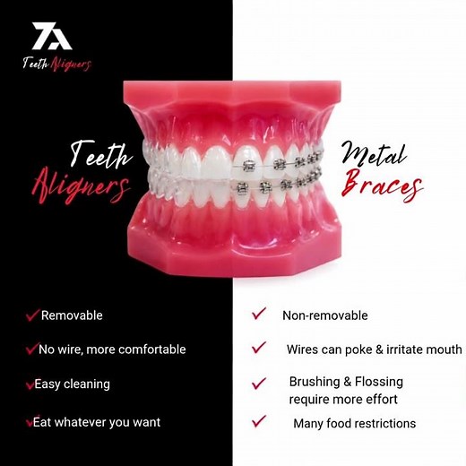 Clear Aligners vs Metal Braces: Which Is Best For You? 🤔