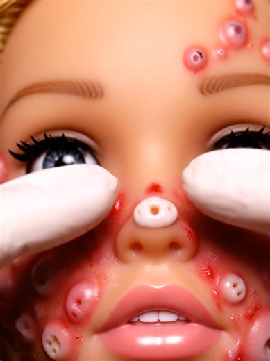 ASMR Pimple Popping with Toys for Skincare Enthusiasts