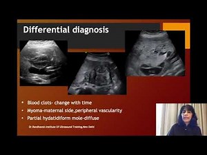 Ultrasound-Placenta -Chorioangioma