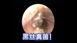 【星医生】真菌性外耳道炎黑色菌丝
