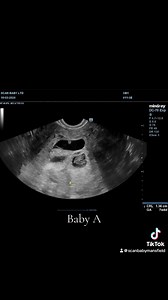 👶🏼👶🏼👶🏼 TRIPLE the surprise! Have you ever seen triplets on an ultrasound? Because we have… and it’s the sweetest chaos ever! 💕✨ Imagine walking in thinking you’re seeing one little heartbeat… and leaving with three! 😅🥹 Our availability for the rest of the week: 🗓️ Wednesday, 10am-4pm 🗓️ Friday, 10am-6pm 🗓️ Saturday, 9am-6pm 🗓️ Sunday, 9:30am-5:30pm We have scans for every stage of pregnancy—from the very first peek to magical 4D bonding moments: ✨ Early pregnancy reassurance scans (