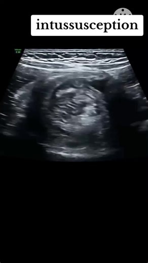 Understanding Intussusception on Ultrasound Imaging