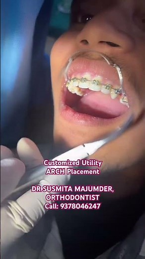 Arch placement in orthodontic treatment #dentist #dentalclinic