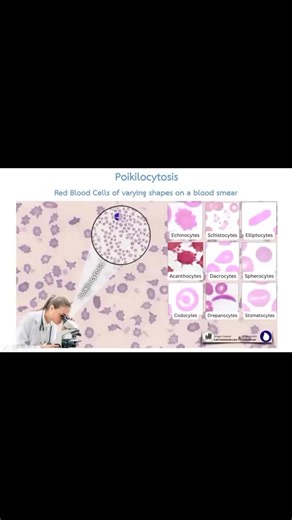 Rose Apple on Instagram: "🌺 Poikilocytosis 🌺 ✅The presence of red blood cells with various abnormal shapes . If three or more distinct morphological abnormalities (≥3 types ) are identified, Poikilocytosis should be included in the report. ✅Common morphological abnormalities include: 🔹Target cells (codocytes) 🔹Schistocytes (fragmented cells) 🔹Teardrop cells (dacrocytes) 🔹Spherocytes 🔹Elliptocytes/Ovalocytes 🔹Acanthocytes 🔹Burr cells (echinocytes) 🌺 Reporting example : Case 1 : Ovalocyt