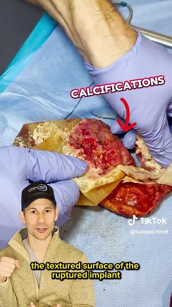 Understanding Breast Implant Maintenance and Explant Surgery