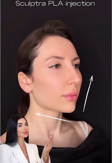 Sculptra PLA - Maximum Lifting & Collagen Boost! 💉 Sculptra is the ultimate non-surgical solution for maximum lifting and skin rejuvenation. Unlike traditional fillers, it stimulates natural collagen production, restoring lost volume and improving skin firmness over time. ✔️ Powerful Lifting Effect – Tightens and redefines facial contours. ✔️ Deep Collagen Stimulation – Enhances skin structure and elasticity. ✔️ Long-Lasting Results – Visible improvement for up to 2 years. ✔️ Natural & Gradual 