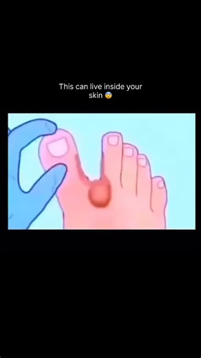 MBBS Notes | NEET Guide 🩺 | 📌 Myiasis – What it is & How it is removed Myiasis is the infestation of human or animal tissue by fly larvae (maggots). The flies lay... | Instagram