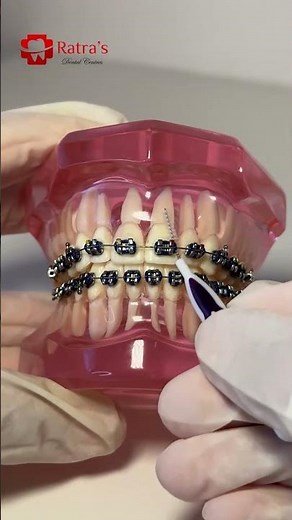Braces Cleaning Tips | How to Clean Teeth with Braces Properly 🪥 | Ratra Dental Noida