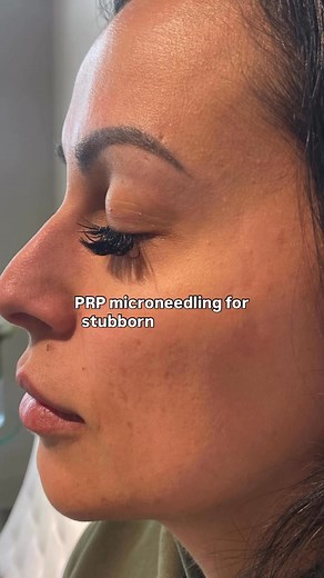 Tired of treatments that promise results but don’t deliver? 😩 Our client was too—until she tried PRP microneedling (aka the vampire facial) at DermaLux. After just 2 sessions, her acne scars were softer and her skin was noticeably smoother and brighter✨ It’s your turn to love your reflection again 💕 Book your free consultation today. | DermaLux Medical Aesthetics