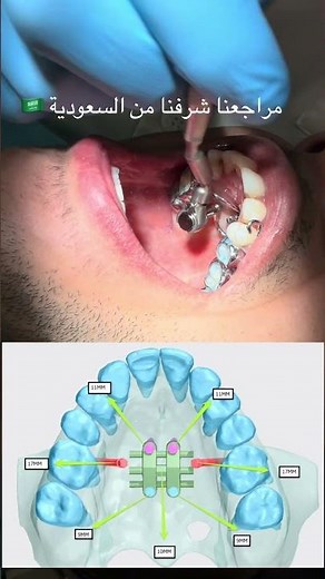 #marpe expander installation for patient came from #ksa 🇸🇦