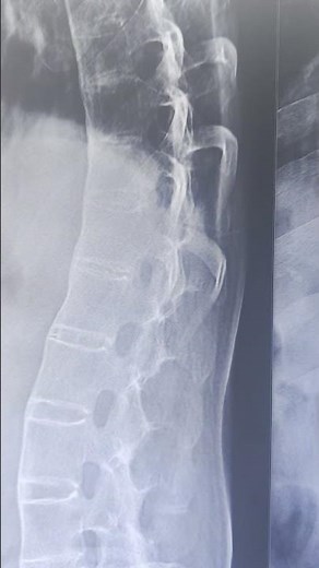 Ankylosing Spondylitis Explained | Why Spine Gets Fused & Becomes Stiff