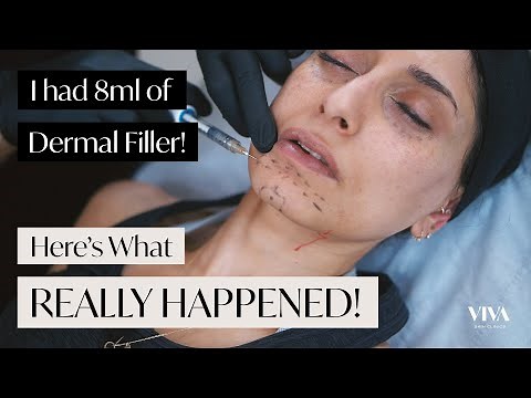 Full Face Dermal Filler! 😱 Here's what REALLY happened! (2021)