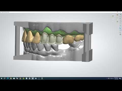 Designing a Crown oral scan in 3Shape, custom-designed based on client requirements