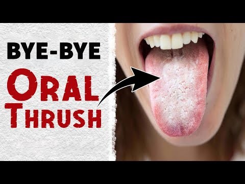 Stop Oral Thrush Fast | Effective Home Treatment