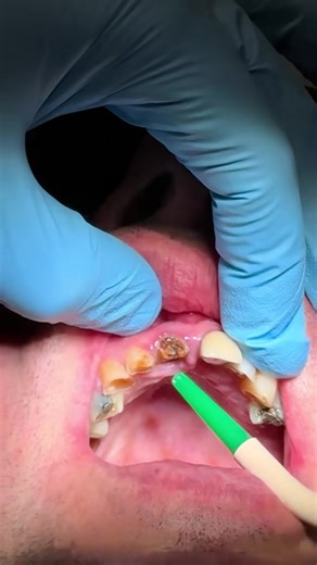 Extraction simplified. | cell extraction