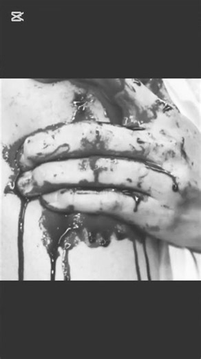 Hemophobia. Fear of abnormal Blood