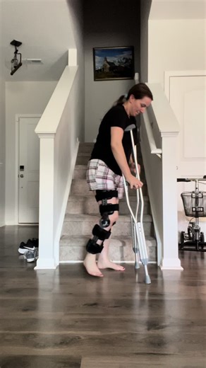 Going up the stairs after surgery on proximal hamstring tendon tears of the right leg with 4 cm retraction of the tendons and the hamstring muscle.