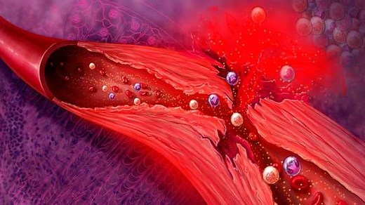 Mayo Clinic Minute: What is Takayasu's arteritis? - Mayo Clinic News Network